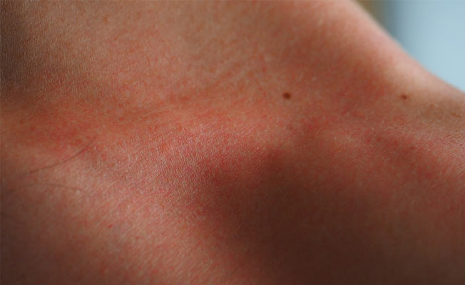 Deri Kanserine Dikkat